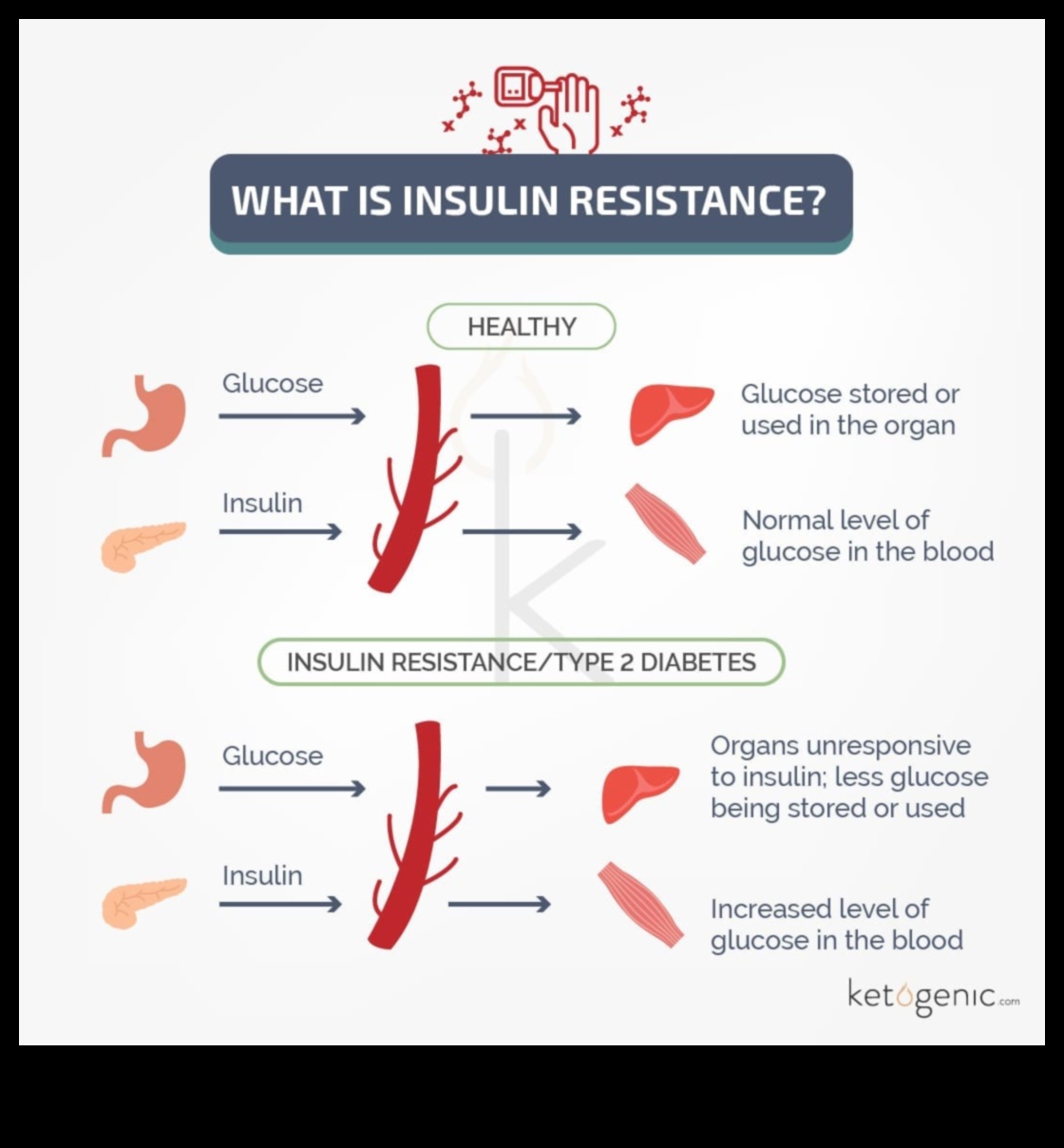 רגישות קטו ואינסולין: ניווט במערכת היחסים